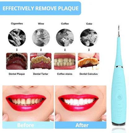 SonicSmile Pro Tartar Cleaner
